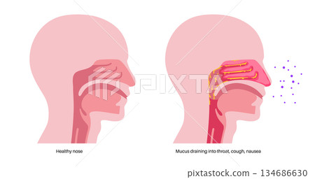 Postnasal drip poster 134686630