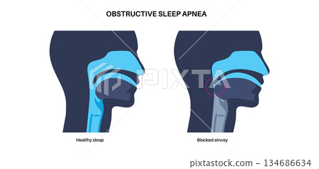 Obstructive sleep apnea Obstructive sleep apnea 134686634