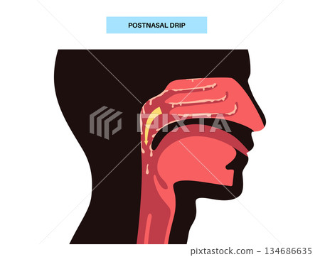 Postnasal drip poster Postnasal drip poster 134686635