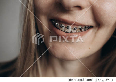 A girl with braces. Visit to the dentist. Beautiful smile 134703604