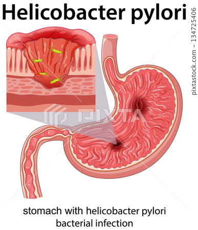 Stomach Cross-Section Showing Helicobacter Pylori Bacterial Infection 134725406