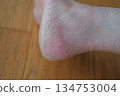 腳跟乾燥皸裂 134753004