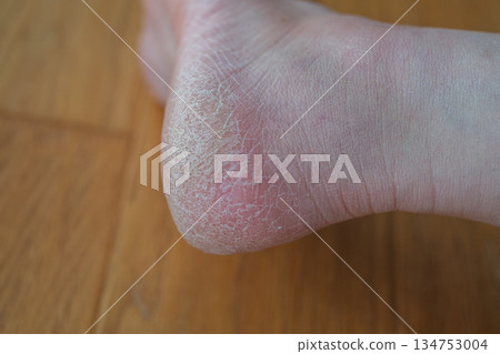 Dry and cracked heels 134753004