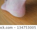 腳跟乾燥皸裂 134753005