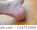 腳跟乾燥皸裂 134753006