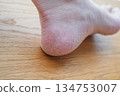 腳跟乾燥皸裂 134753007
