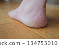 腳跟乾燥皸裂 134753010