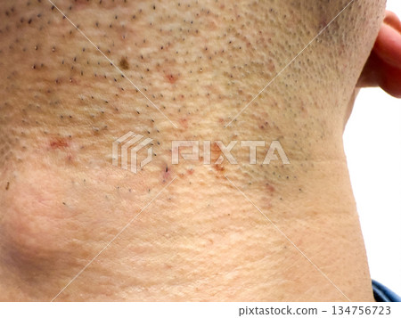 男人剃鬚後的皮膚 男人剃鬚後的皮膚 134756723