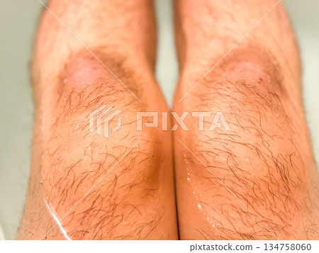Hairy knees, unwanted hair, men's aesthetic treatment 134758060