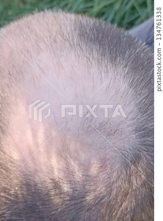 A close-up reveals a balding head with noticeable thinning hair and a receding hairline, highlighting concerns about hair loss and aging. Ideal for healthcare or lifestyle topics. 134761338