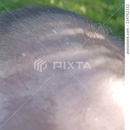 A close-up view of a scalp shows thinning hair and early baldness. Sunlight enhances the skin texture and hair follicles, suitable for medical or cosmetic discussions. 134762132