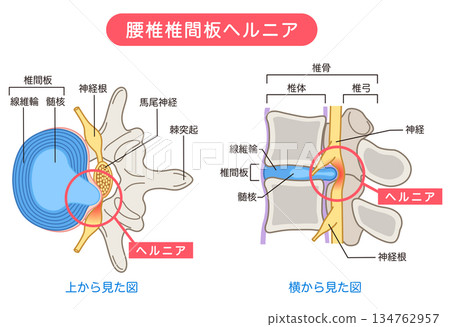 Lumbar disc herniation, structure of the intervertebral disc, lower back pain Lumbar disc herniation, structure of the intervertebral disc, lower back pain 134762957