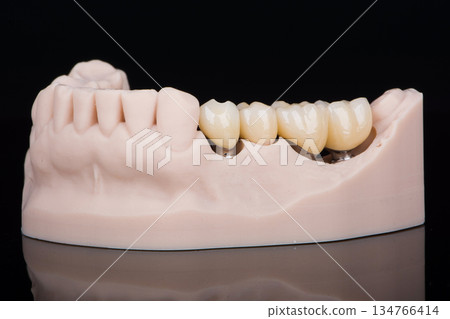 Dental bridge made of zirconium on three titanium abutments to fixation on implant 134766414