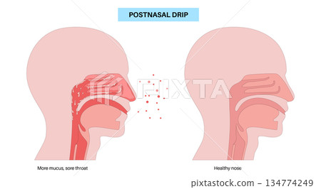 Postnasal drip poster 134774249