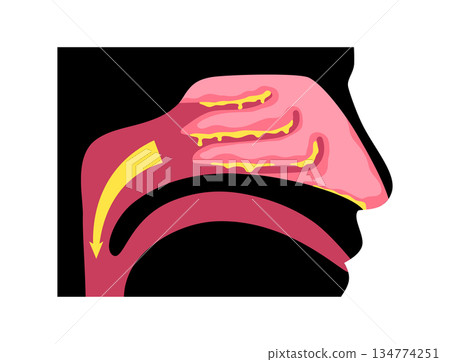 Postnasal drip poster Postnasal drip poster 134774251