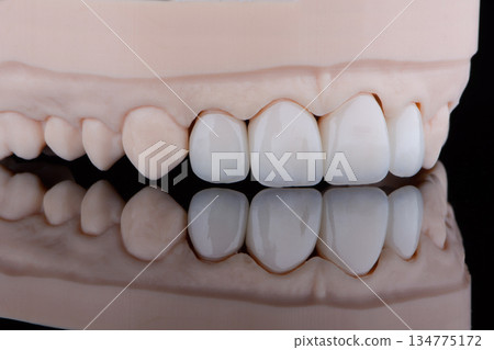 Four dental ultra-thin ceramic veneers in bleach color for fixation to frontal teeth of upper jaw. 134775172