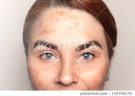 Looking at camera woman with pigmentation, melasma, freckles, age spots close up photo. 134788278