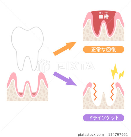 Normal recovery and dry socket after tooth extraction 134797931