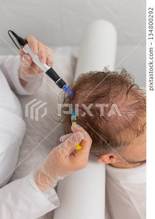 Trichologist doing man improve hair growth procedure, dermapen microneedling, vitamin injections 134800292