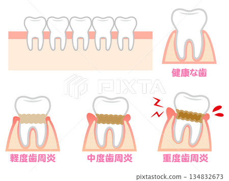 牙周病牙齦與牙齒插畫材料集 2 134832673