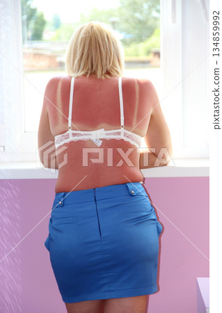 Modern woman in bra with sunburn on her back in blue skirt standing with her back Modern woman in bra with sunburn on her back in blue skirt standing with her back 134859992