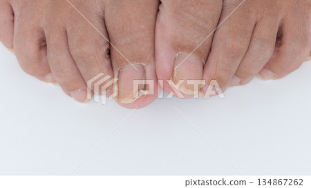 Close-up view of toenails affected by nail fungus disease, showcasing discoloration and texture, emphasizing the importance of foot health awareness Close-up view of toenails affected by nail fungus disease, showcasing discoloration and texture, emphasizing the importance of foot health awareness 134867262