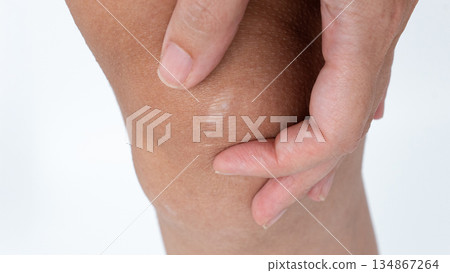 Close-up of a hand gently pressing on a knee, showcasing skin texture and highlighting the importance of joint care and health awareness 134867264