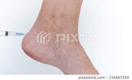 Varicose veins on leg being treated with injection, showcasing medical procedure and highlighting skin texture and condition of the affected area 134867269