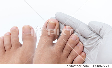 Close-up of a healthcare professional examining a patient's toenail for signs of nail infection, highlighting the importance of foot health and care Close-up of a healthcare professional examining a patient's toenail for signs of nail infection, highlighting the importance of foot health and care 134867271