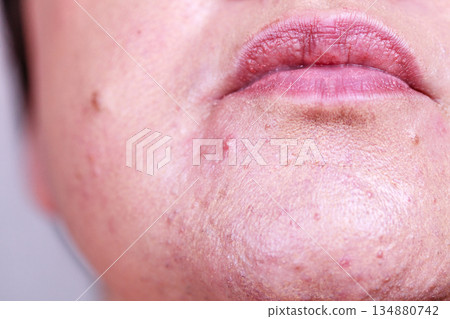 Female face with acne skin problem Female face with acne skin problem 134880742