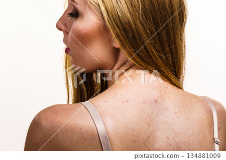 Woman with skin problem acne on back 134881009