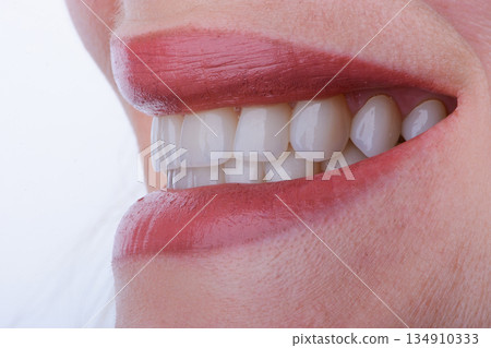 Female smile makeover by dental ceramic veneer, porcelain laminate veneers. Side view Female smile makeover by dental ceramic veneer, porcelain laminate veneers. Side view 134910333