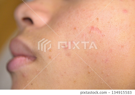 特寫鏡頭拍攝的兒童臉頰，可見痤瘡疤痕和粗糙的皮膚 134915583