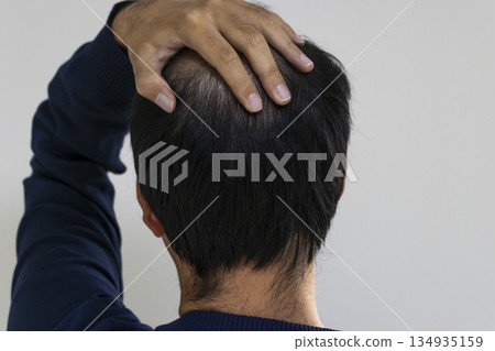 一位三十多歲的男子用手遮住日漸稀疏的頭髮。 一位三十多歲的男子用手遮住日漸稀疏的頭髮。 134935159