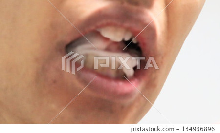 A person biting gauze after wisdom tooth extraction 134936896