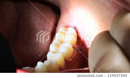 拔除智齒後口腔內部的狀況 134937309