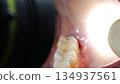 Inside the mouth after removing stitches after wisdom tooth extraction 134937561