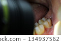 The inside of the mouth with food particles stuck in the gap after wisdom tooth extraction 134937562