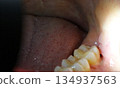 Inside the mouth after removing stitches after wisdom tooth extraction 134937563