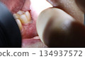 The inside of the mouth with food particles stuck in the gap after wisdom tooth extraction 134937572