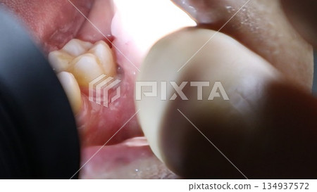 拔除智齒後，口腔內食物殘渣會滯留在牙縫中。 134937572