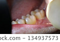 The inside of the mouth with food particles stuck in the gap after wisdom tooth extraction 134937573