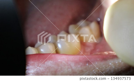 拔除智齒後，口腔內食物殘渣會滯留在牙縫中。 134937573