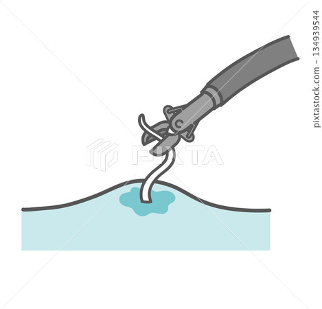 內視鏡切除異尖線蟲的示意圖 134939544