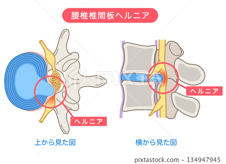 腰椎間盤突出、椎間盤結構、下背痛 134947945