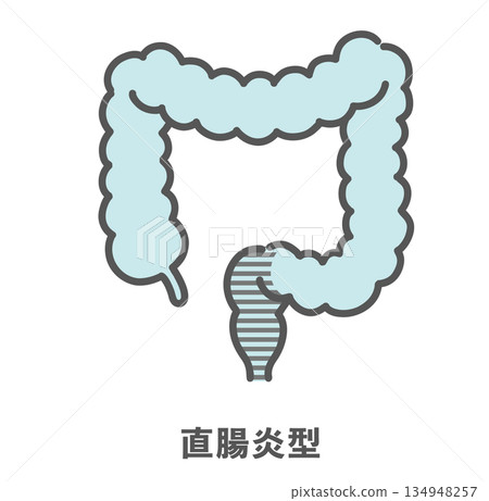 Illustration of ulcerative colitis and proctitis (lesion range) Illustration of ulcerative colitis and proctitis (lesion range) 134948257