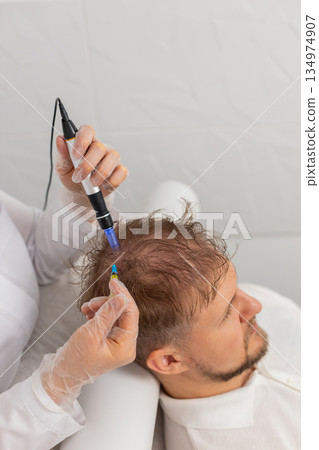 Trichologist doing man improve hair growth procedure, dermapen microneedling, vitamin injections 134974907