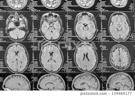 Magnetic resonance imaging or MRI image of the brain Magnetic resonance imaging or MRI image of the brain 134984177