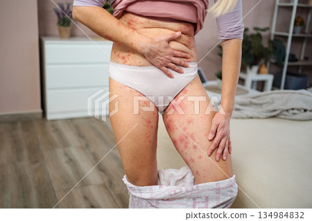 Woman dealing with allergic skin rash and irritation Woman dealing with allergic skin rash and irritation 134984832