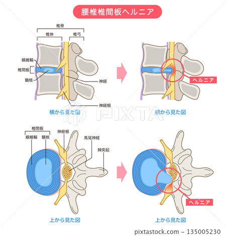 腰椎間盤突出、椎間盤結構、下背痛 135005230